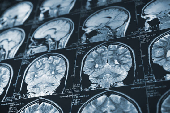 Brain-and-Neurosurgery